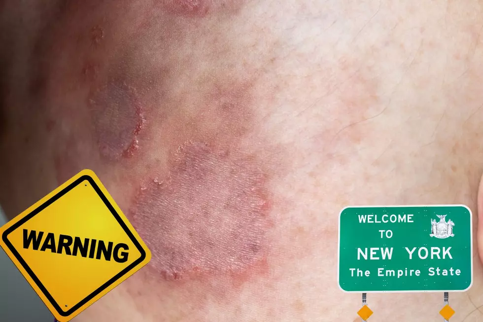 Rare & Extremely Contagious Fungal STD Found In New York State